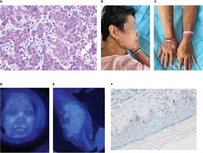 Case Report: Immune checkpoint inhibitor-related vitiligo-like depigmentation in non-melanoma advanced cancer: A report of three cases and a pooled analysis of individual patient data